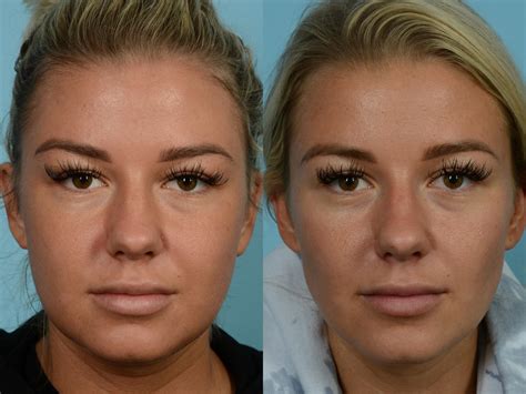 buccal fat removal doctors